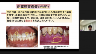 診断力を上げる、口腔粘膜疾患鑑別のポイント | WHITE CROSS